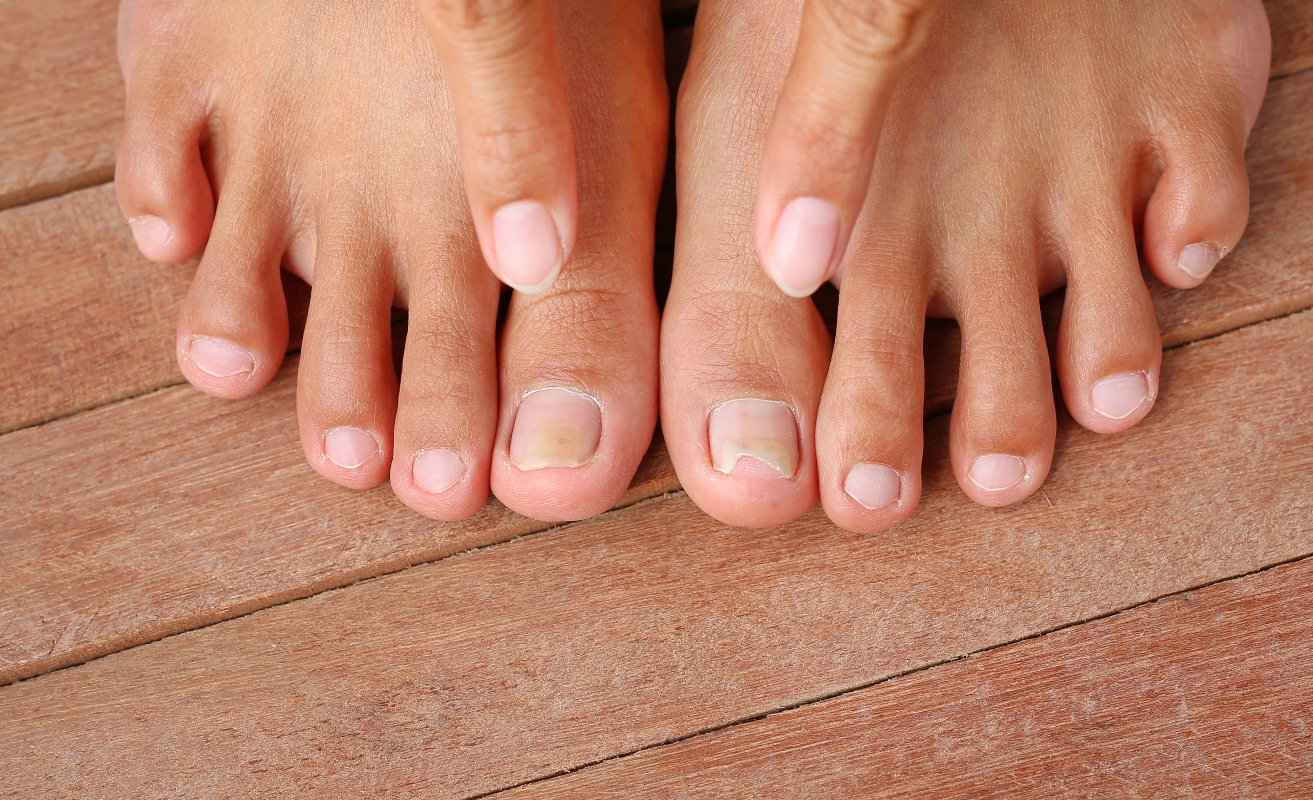 Onychomycosis-causes-risk-factors